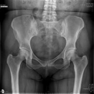 Arthroscopie de hanche